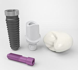 implant-abutment-crown